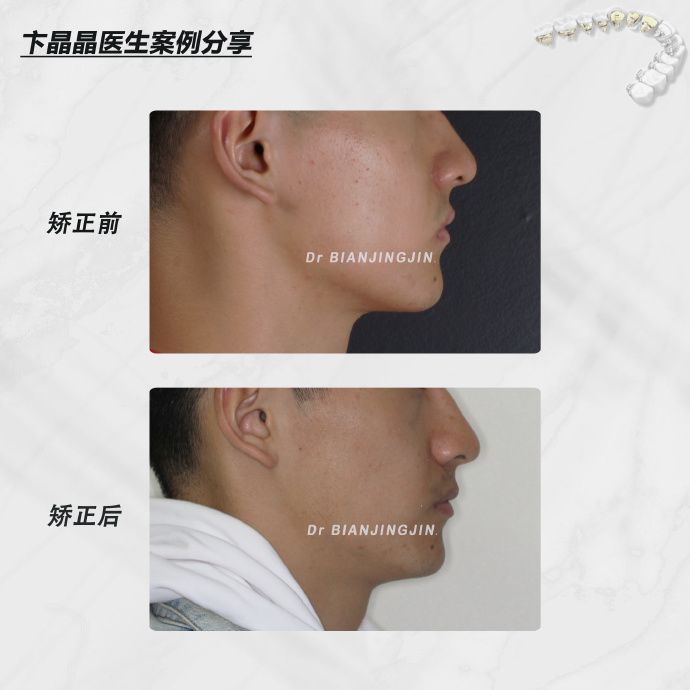 沈阳矫正牙齿大概多久能矫正过来,沈阳牙齿代偿矫正哪里好