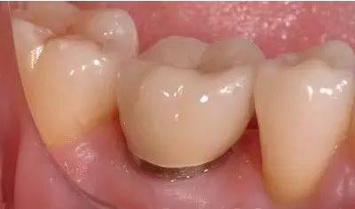 牙缝越来越大是什么导致的,牙缝越来越大什么病中医怎么说