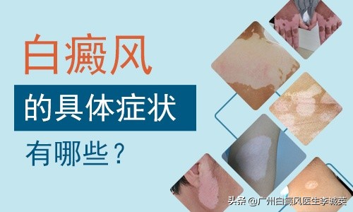人身上为什么会出现白癜风,肉眼看不到的白癜风是属于什么
