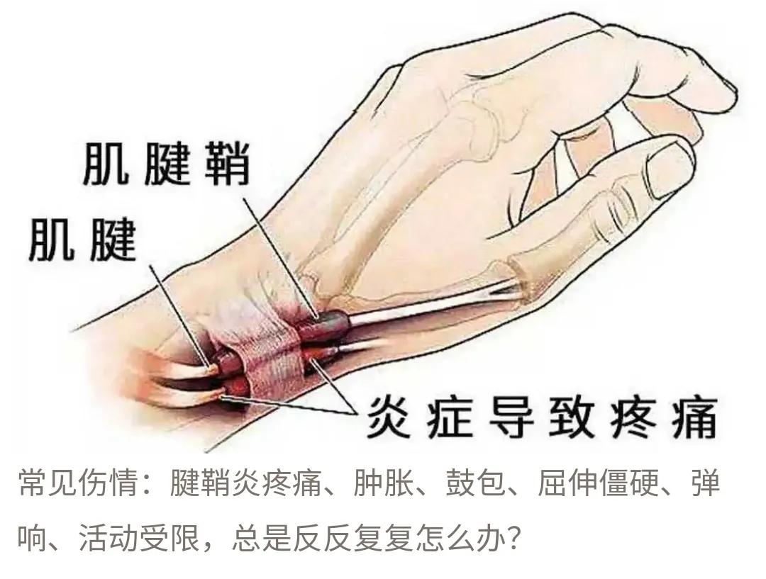 狭窄性腱鞘炎的诊断及治疗。