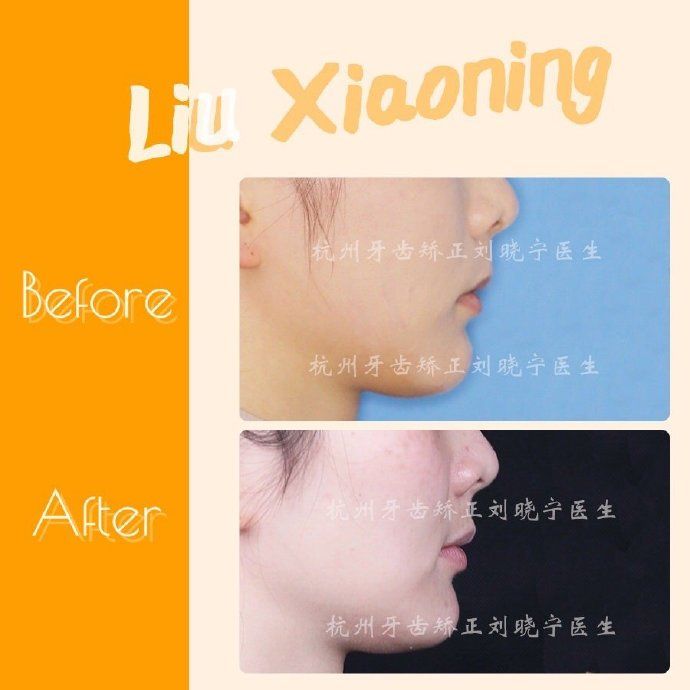 杭州舌侧牙齿矫正,舌侧矫正杭州价格