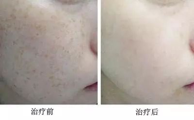 怎样祛斑是MM们的长久烦恼,教你几招
