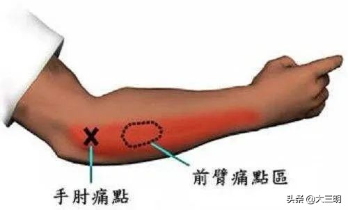 顽固性网球肘的敲打治疗,网球肘针刀效果怎么样