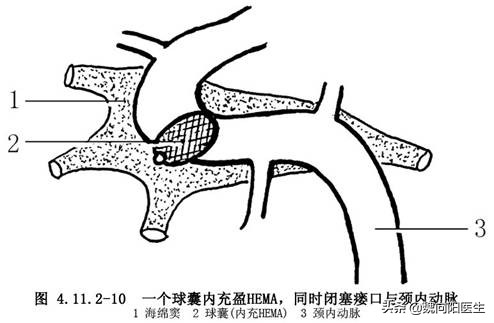 颈动脉海绵窦瘘症状,颈动脉海绵窦瘘介入需要多少钱