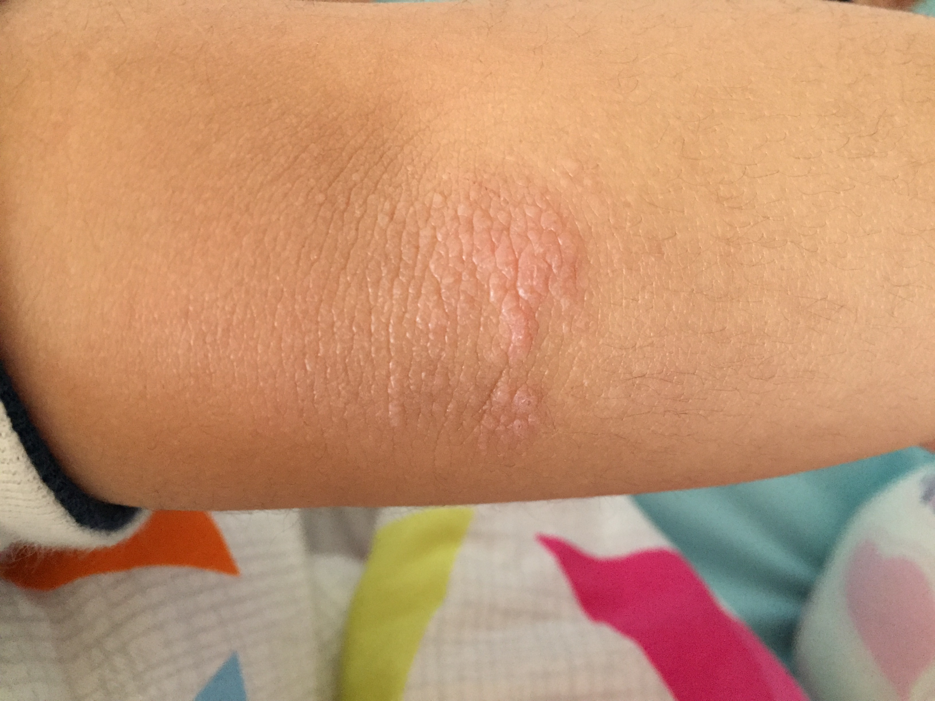 皮肌炎或多发性肌炎的诊断标准,成人皮肌炎与儿童皮肌炎区别