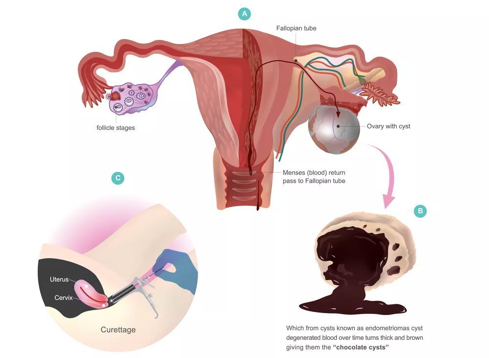 巧克力囊肿会导致卵巢功能差吗,卵巢有巧克力囊肿怎么治