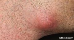 身上有个肿瘤要切除吗,怀疑其他部位有肿瘤需要怎么检查