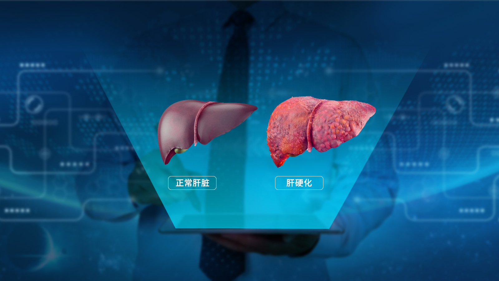 肝硬化导致肝衰竭有保守的方法吗,肝硬化为什么要注意保肝