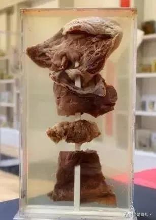 150年来从人体内取出的各式物品