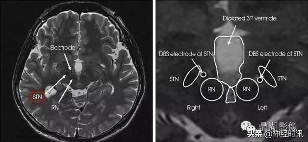基底节ct解剖示意图,影像解剖图谱怎么用