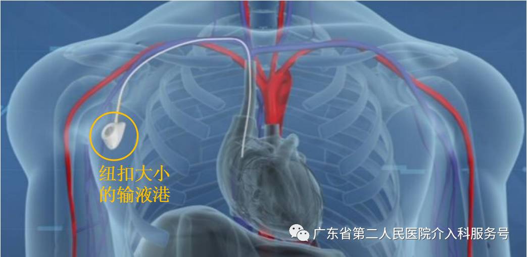 输液港能多次做吗,输液港可以重复使用吗