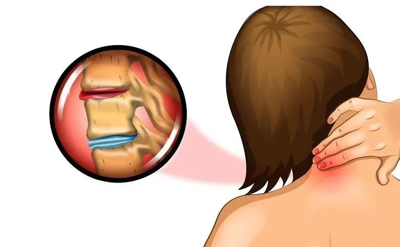 长期手麻是颈椎的问题吗,手麻背后隐藏6大疾病