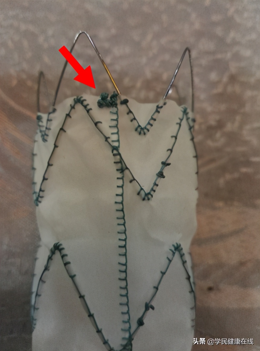 腹主动脉瘤术后内瘘怎么办,腹主动脉瘤出现内瘘解决办法