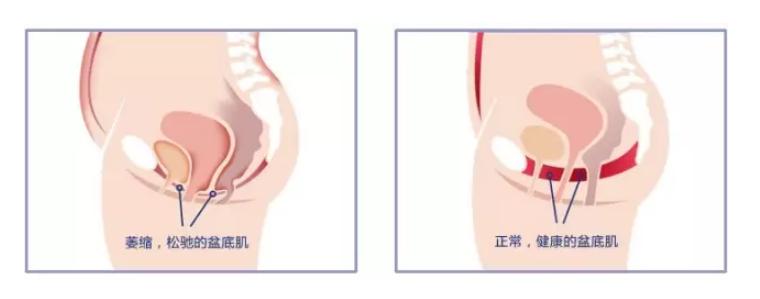 生完宝宝小便频繁是怎么回事,生完宝宝小便解不出来有什么后果
