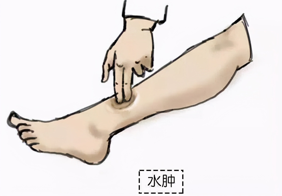 男子多尿是什么原因,男子肾衰竭什么反应