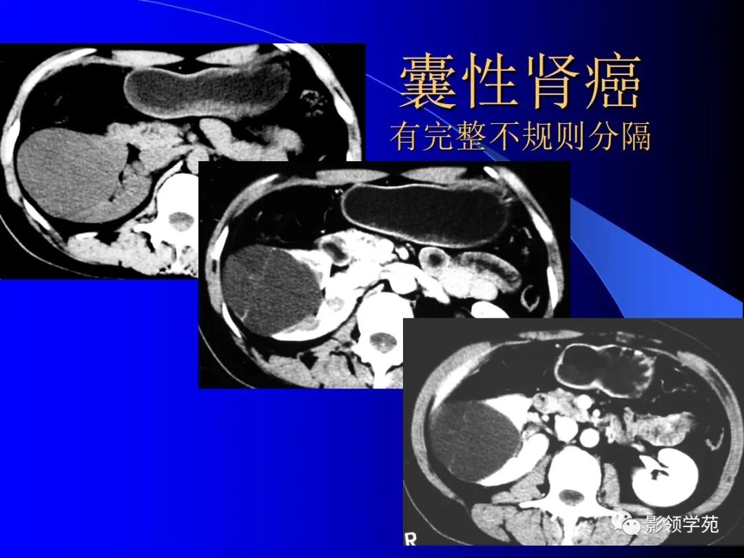 肾脏囊性肿块的影像学特点,肾脏典型病理图片及解析