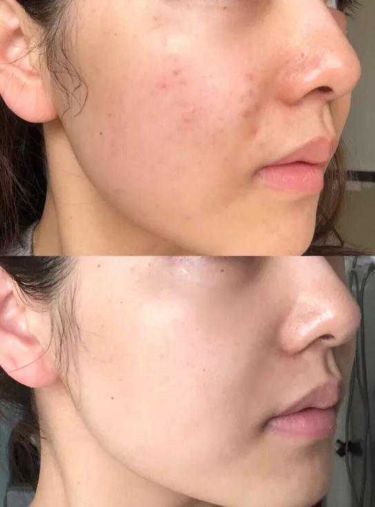 点阵激光祛痘印的副作用和危害,co2点阵激光危害