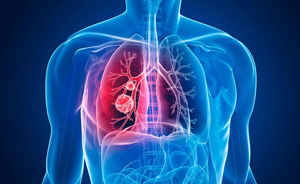 肺癌靶向药吉非替尼多少钱,肺癌靶向药吉非替尼医保可报销吗