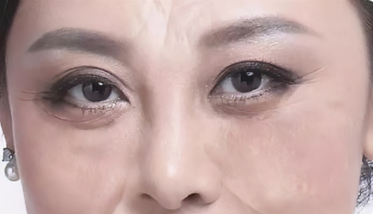 黑眼圈特别丑该怎么办,黑眼圈让人又老又难看