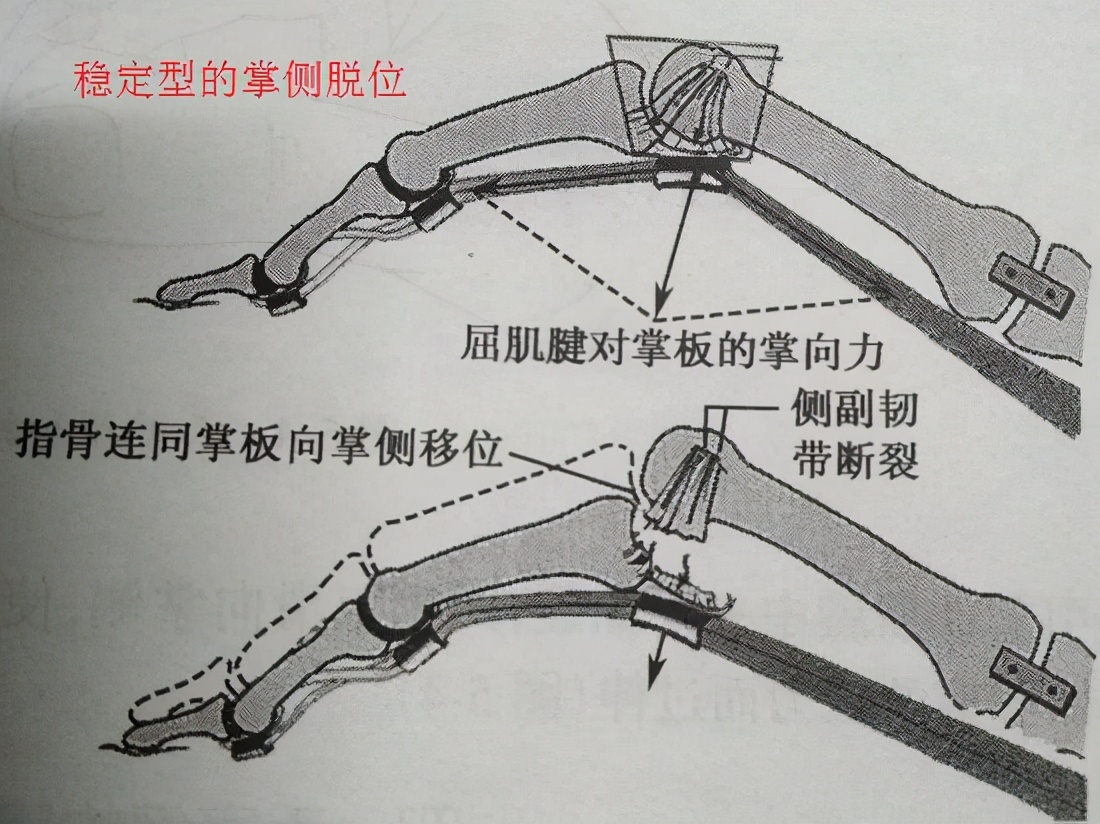肩关节脱位骨折康复,跗跖关节骨折脱位康复视频