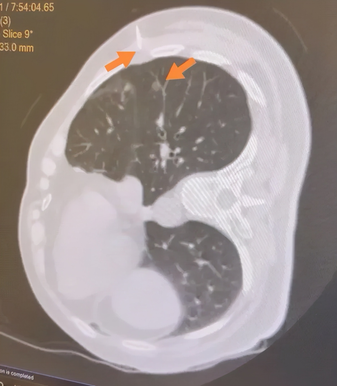肺结节多学科联合诊疗,多学科会诊肺结节