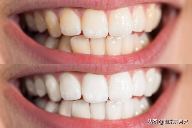 一岁宝宝牙齿上有黄垢怎么办,牙齿上的黄垢可以用刀子刮掉吗