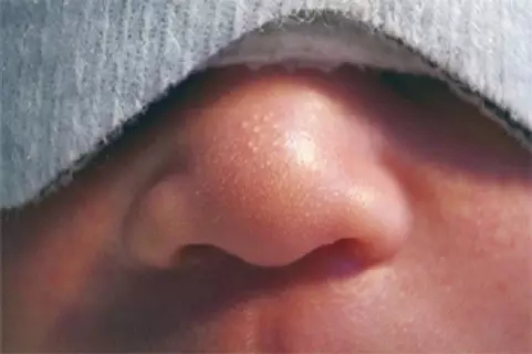 新生儿咳嗽湿疹,新生儿湿疹的治疗方法有问必答