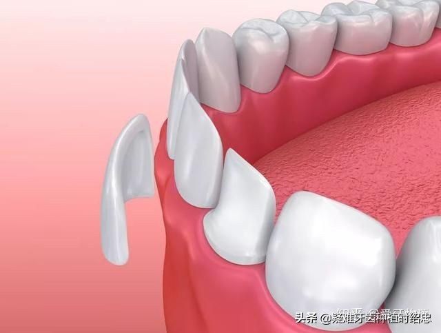 400与300块钱的烤瓷牙有多大区别,为什么有的全瓷牙贵有的便宜