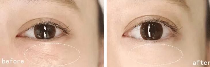 玻尿酸蒸汽热敷眼罩有用吗,热敷眼罩可以加速玻尿酸代谢吗