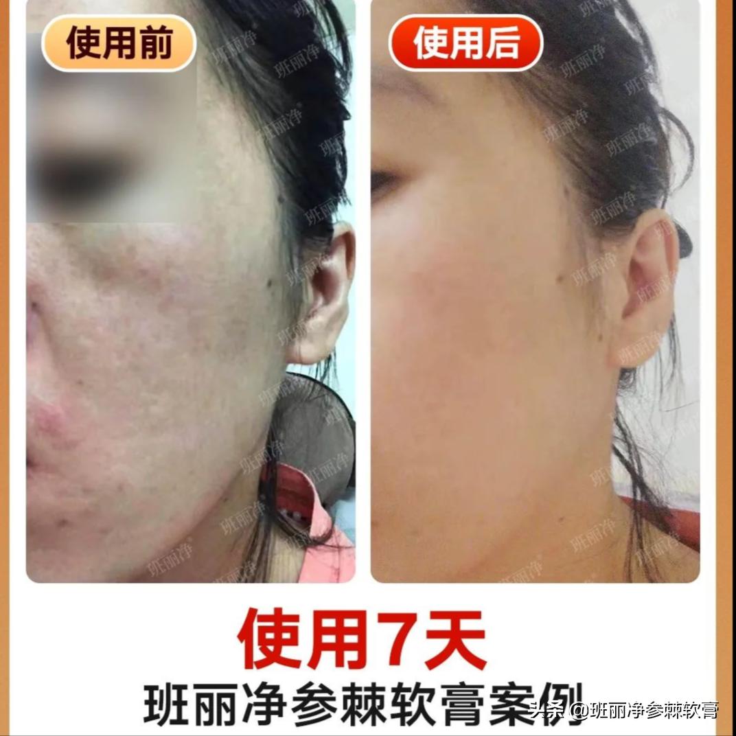 现在很多人都在祛斑靠谱吗,到底祛斑是真的还是假的