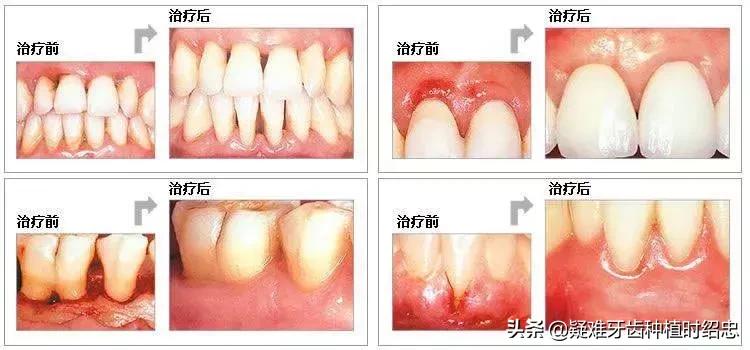 牙周炎牙齿松动要拔掉吗,牙周炎引起牙齿松动严重需要拔吗