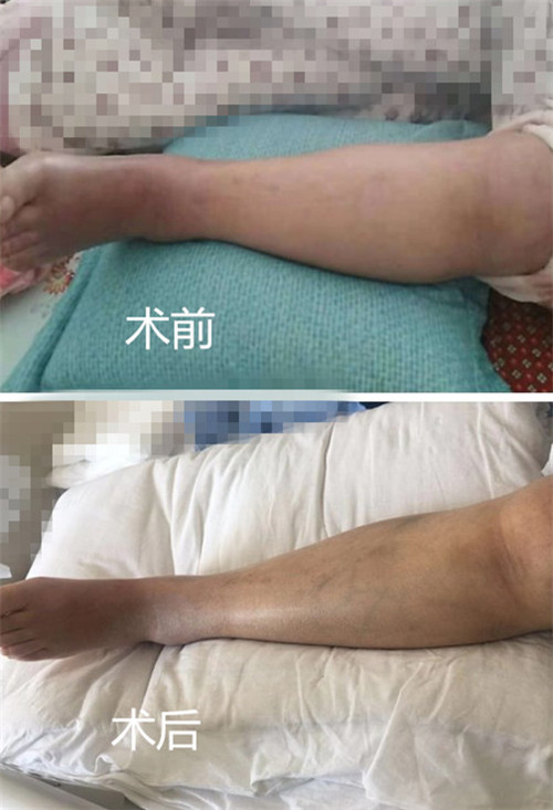 下肢深静脉血栓介入治疗,下肢深静脉血栓介入治疗视频