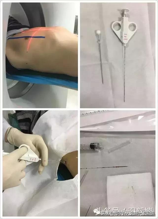 肺癌诊断与微创综合治疗,肺癌晚期的微创介入治疗