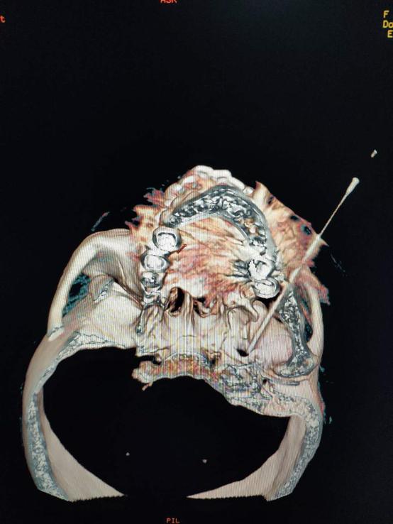 一针消除三叉神经,三叉神经痛一针8000