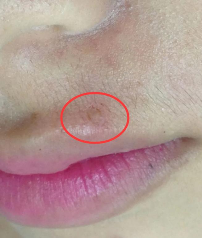 点痣留下了疤痕怎么祛,点痣留下的疤痕怎么消除最有效