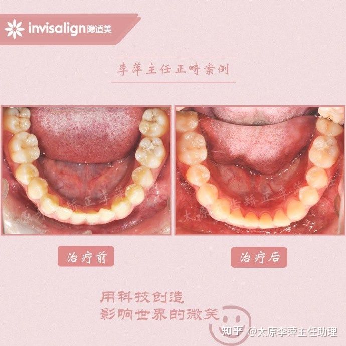 太原矫正牙齿需要做正颌吗,太原牙齿二次矫正