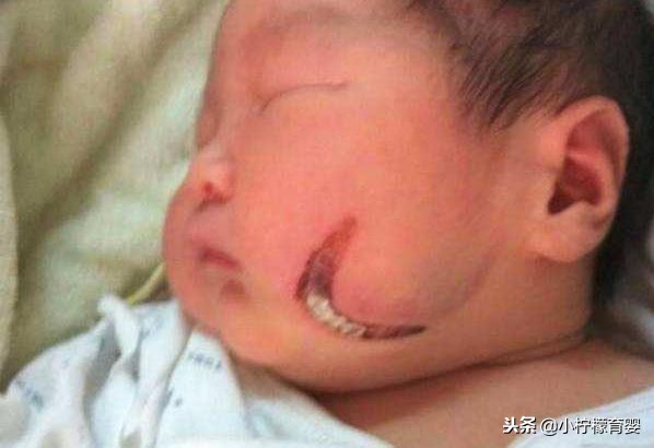 都说产钳助产危险，为什么还会有这种助产方式，对母婴影响如何？