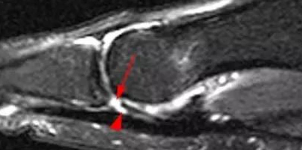 啥是草皮,啥叫草皮趾