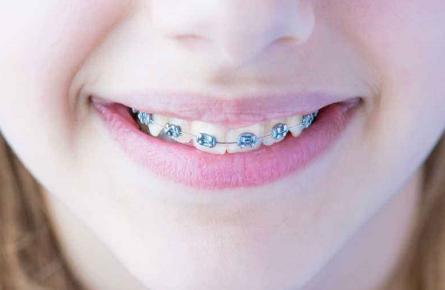 深圳正畸科医生口碑,正畸托槽掉了去诊所要收费吗