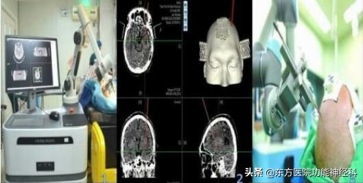 精神病手术治疗的效果如何,手术治疗难治性精神疾病