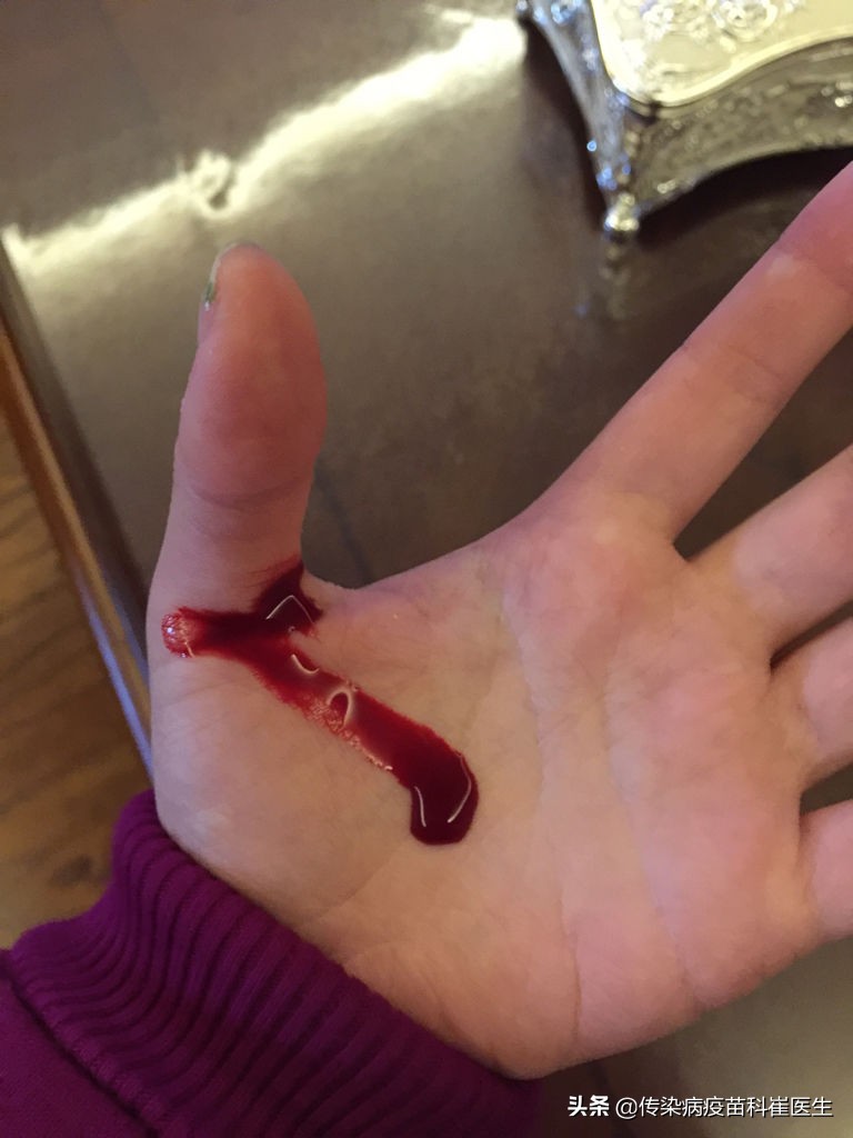 破伤风过敏能打结核菌素吗,打破伤风针多久可以接种新冠疫苗