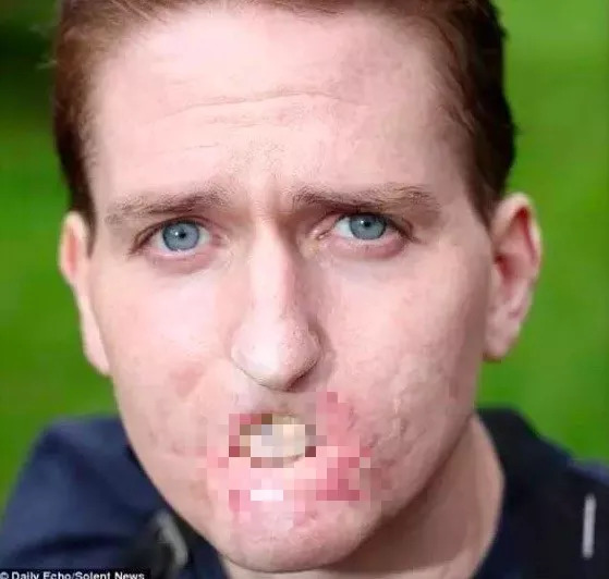 紧急！全澳多地出现“吃人菌”，感染后如同丧尸！24小时可吃一人