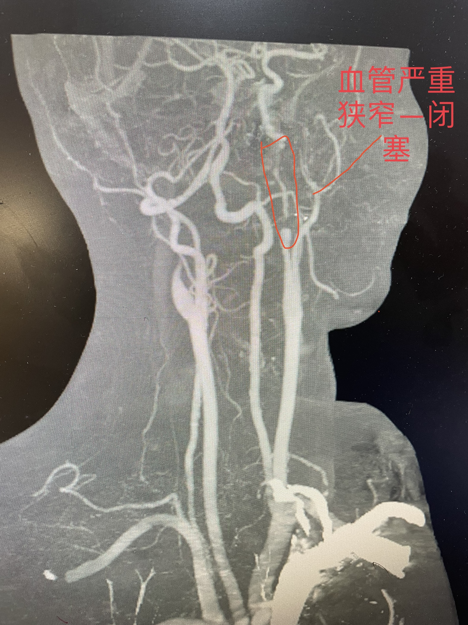 颈动脉狭窄严重可以支架恢复吗,颈动脉狭窄治疗之后心脏会缓解吗