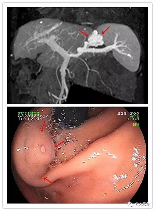 门静脉高压介入治疗好吗,缓解门静脉高压微创手术