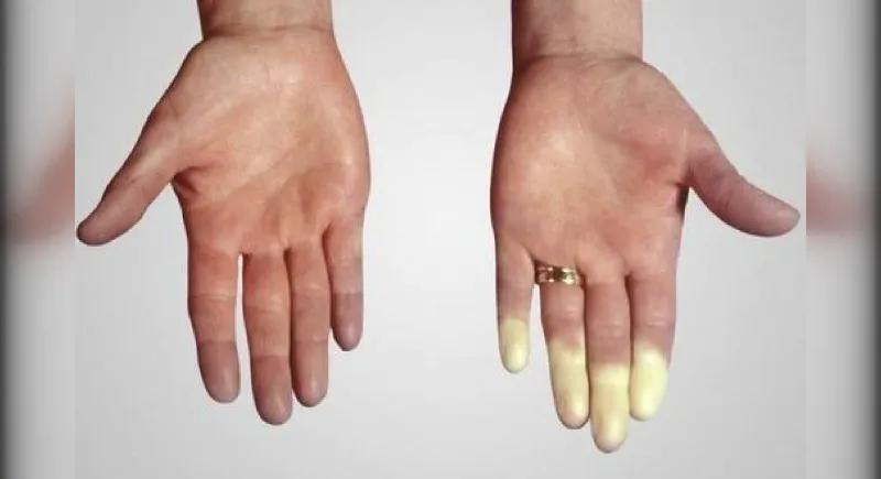 冬天冷的手变白怎么回事,冬天冷手指发白怎么回事