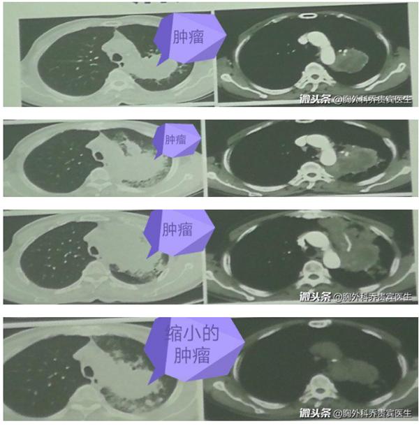 免疫治疗假性进展引起呼吸困难,免疫治疗出现假性进展在什么时候
