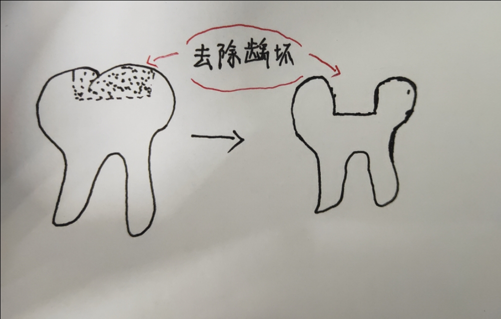 口腔牙齿出了问题怎么办,牙医说牙齿有洞怎么处理