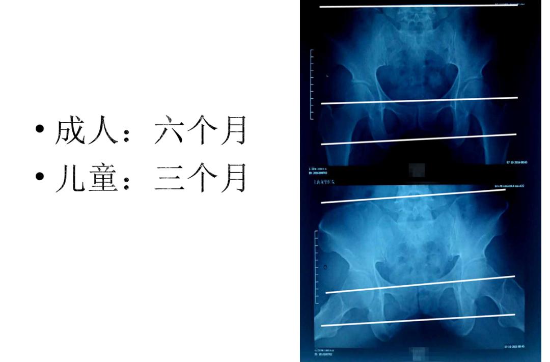 对股骨头缺血性坏死疼痛的治疗体会