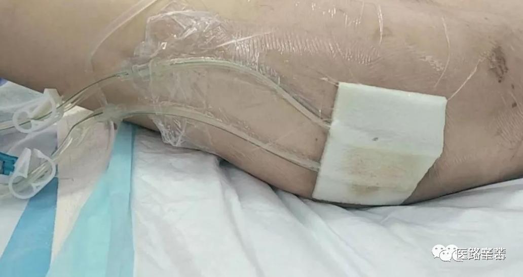 伤口换药技术操作流程视频,如何换药包扎伤口
