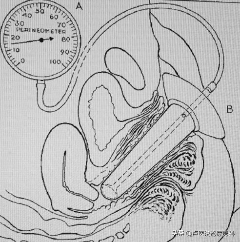怎么锻炼盆底肌凯格尔运动,盆底肌训练凯格尔运动教程